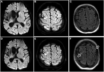 Panitumumab-Associated Encephalopathy after Accidental Intra-arterial Application through Dislocated Central Venous Access Device